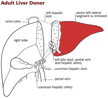 Living Donor Program | CHLA