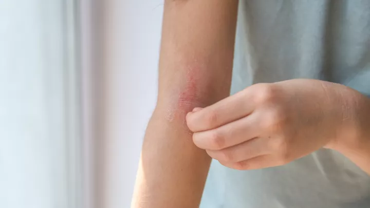 light skinned child scratching reddened area in inner elbow