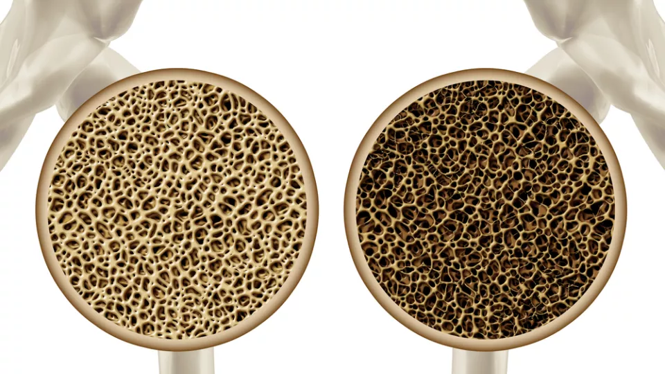 Cross section illustration of two femur bones comparing their bone density