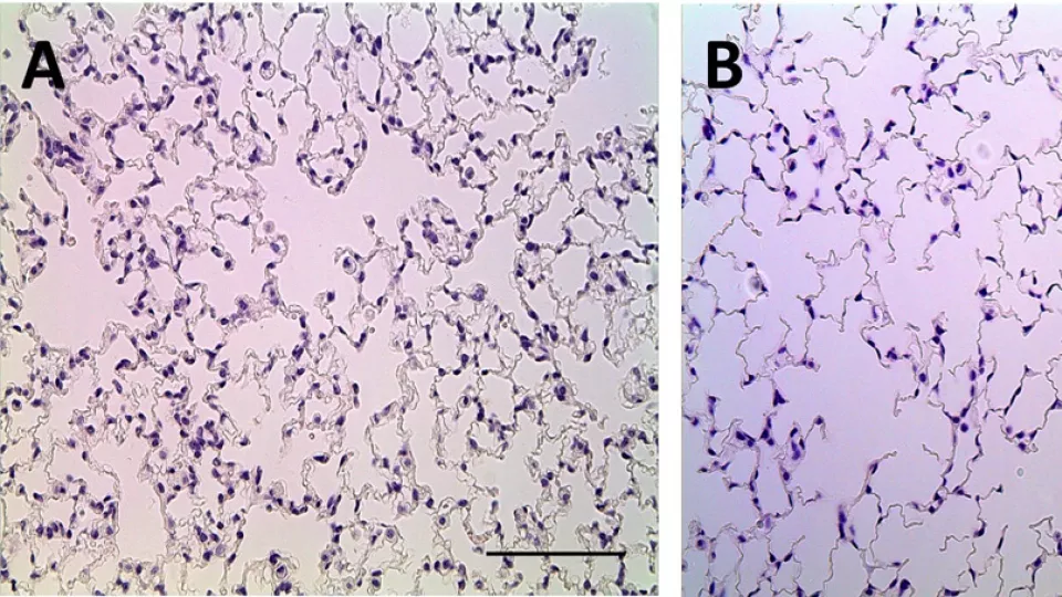 Side-by-side comparison of damaged and undamaged lung cells