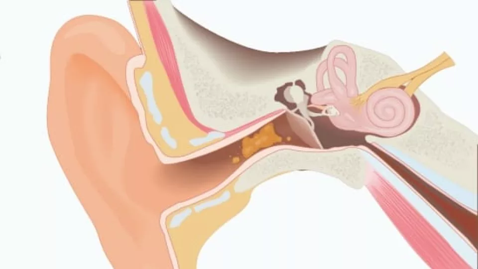 The best way to clean a child's earwax - CHOC - Children's health hub