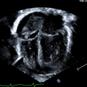 A black-and-white image of a heart with a blood clot visible in the upper right chamber