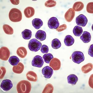 An illustration of purple lymphoblast cell overgrowth in acute lymphoblastic leukemia