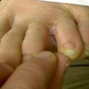 Fungus infection called Tinea manus on the hand. Also known as