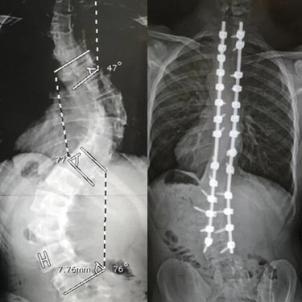 Shona on X: How cool is this?! Scoliosis (spinal fusion) surgery