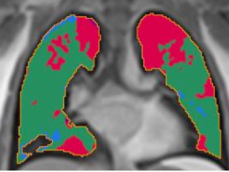 An MRI image outlines two lungs in yellow. The lungs are colored mostly in green, with some large red splotches and tiny areas of blue, against a blurred black and white backdrop.