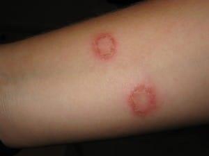 ringworm rash on arm