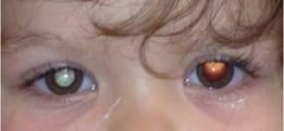 Cobrinik Lab Retinoblastoma.jpg