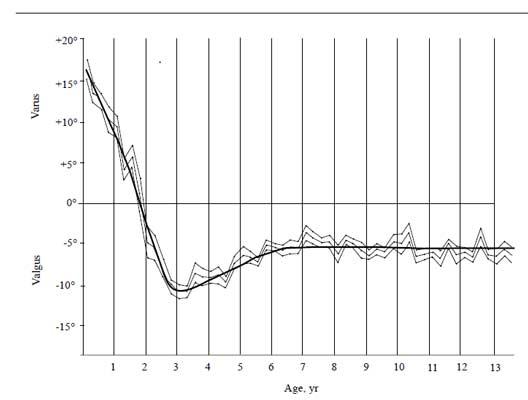 Bowed Legs - Kids Plus Pediatrics