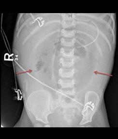 Picture C - X-Ray image of infant torso