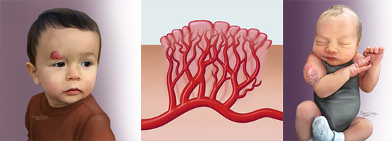 Infantile Hemangiomas | Children's Hospital Los Angeles