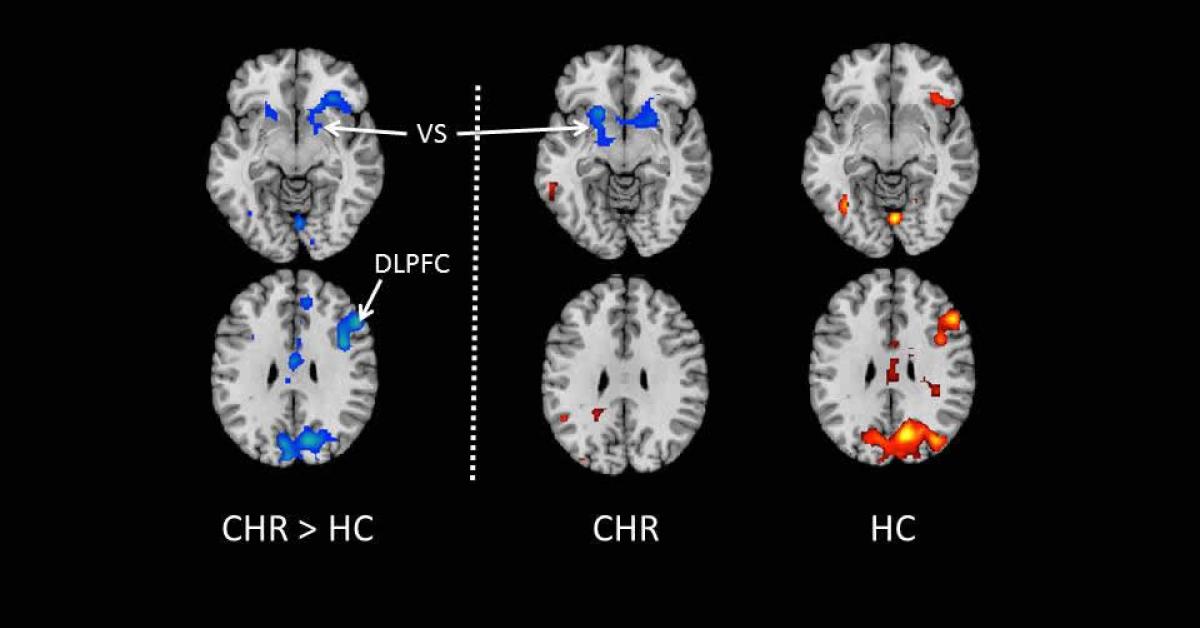 Conflict-Related Brain Activity May Indicate Psychosis Risk | Children ...