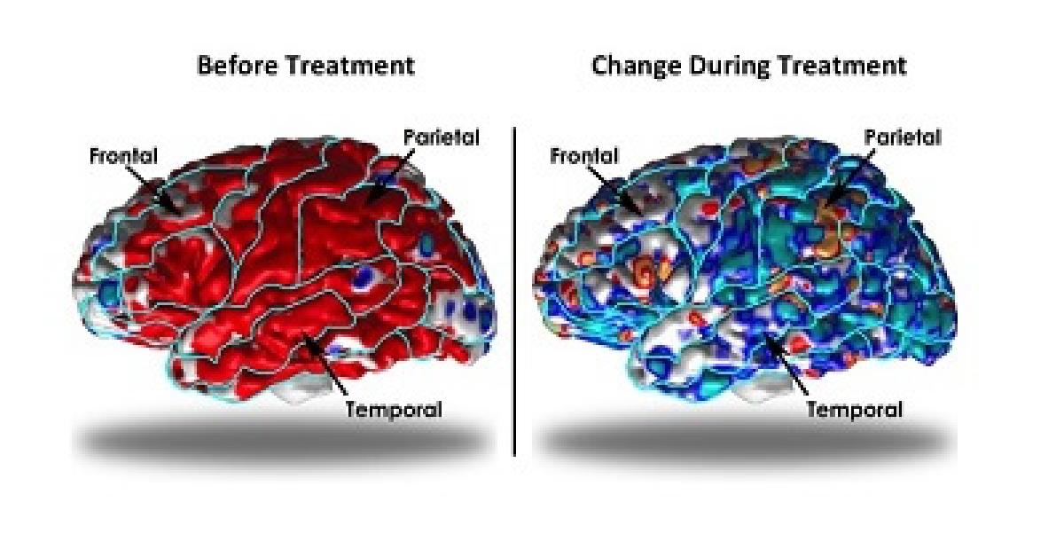 Brain Architecture Alters To Compensate For Depression | Children's ...