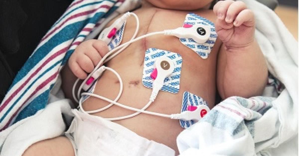 Baby JJ scheduled to have second hypoplastic left heart syndrome